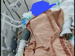 Siti yang Dibakar Mantan Suami Masih Kritis, Biaya Pengobatan Gratis