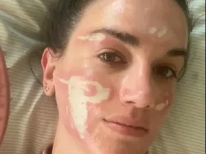 Niat Glow Up, Wanita Malah Alami Luka Bakar Permanen Usai Facial Mahal