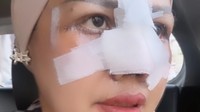 Elly Sugigi Bongkar Biaya Oplas, Ngaku Tak Keluar Uang Sepeser Pun