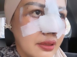Elly Sugigi Bongkar Biaya Oplas, Ngaku Tak Keluar Uang Sepeser Pun