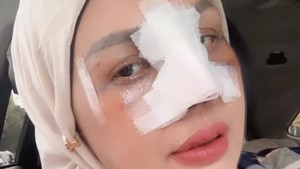 Potret Terbaru Elly Sugigi Setelah Oplas, Kini Berhidung Mancung