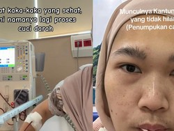 Viral Wanita Bekasi Cuci Darah karena Gagal Ginjal Stadium 5, Ini Gejala yang Dialami