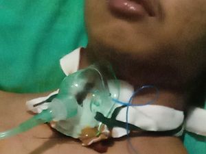 Leher Warga Jembrana Terjerat Kabel WiFi hingga Pita Suara Robek