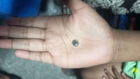 Ngilu! Baterai Jam Masuk Telinga Bocah Tasik, Damkar Turun Tangan