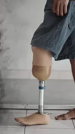 Kaki Palsu untuk Osi Agar Bisa Beraktivitas di Sekolah