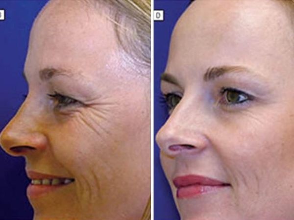 Viral! Foto Beda Wajah Kembar Identik: 20 Tahun Pakai Botox Vs Tidak