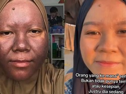 Cerita Wanita Samarinda Kulitnya Menggelap Efek Pakai Krim Merkuri