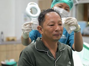 Ringgo Agus Rahman Lanjut Transplantasi Rambut Tahap Kedua, Pilih Produk Lokal