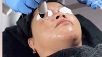 Mencoba Derma Boostox, Kombinasi Skin Booster & Botox dengan Dermapen