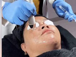 Mencoba Derma Boostox, Kombinasi Skin Booster & Botox dengan Dermapen