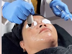 Mencoba Derma Boostox, Kombinasi Skin Booster & Botox dengan Dermapen