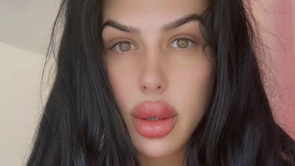 Aksi Nekat Wanita yang Dijuluki Bibir Terbesar, Suntik Filler Sendiri di Rumah