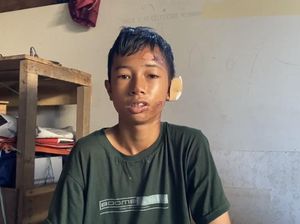 Cerita Relawan Terluka Bakar Usai Halau Karhutla yang Nyaris ke Permukiman