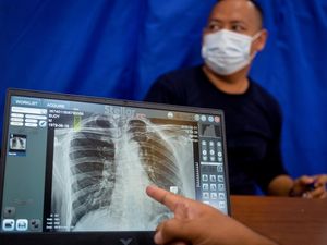 82 Juta Warga Sudah Ikuti Cek Kesehatan Gratis, Penyakit Ini Banyak Ditemukan