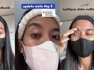 Cerita Warga Alami Pembuluh Darah Pecah di Mata usai Kelilipan Abu Vulkanik