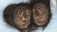 Penampakan Gumpalan Rambut 1,5 Kg yang Diangkat dari Perut Gadis 16 Tahun