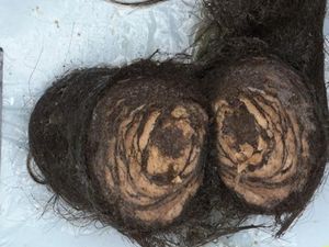 Penampakan Gumpalan Rambut 1,5 Kg yang Diangkat dari Perut Gadis 16 Tahun