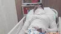 Sepekan Dirawat di RS, Sopir Truk yang Dibakar Bos di Bali Meninggal