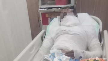 Malangnya Sopir di Bali Dibakar Bos, Luka 68% dan Tak Bisa Bayar Perawatan