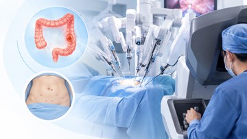 Kanker Usus Besar Bisa Dioperasi dengan Robotik, Kapan Metode Ini Dipilih?