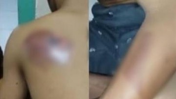 Trauma Berat, Santri Difabel Gresik Disetrika Senior Ogah Mondok Lagi