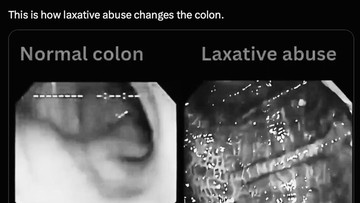 Viral Usus Bermotif 'Kulit Macan' Efek Laxative Abuse, Dokter Pencernaan Angkat Bicara