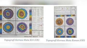 Kisah Pria 26 Tahun di Bandung Berjuang Lawan Keratoconus dan Butuh Donor Kornea