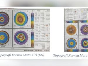 Kisah Pria 26 Tahun di Bandung Berjuang Lawan Keratoconus dan Butuh Donor Kornea