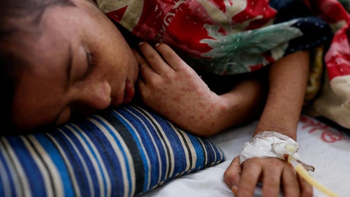 Bangladesh Hadapi Wabah Campak Terburuk di Dunia, Ribuan Anak Meninggal Doctors perform CPR on Esa, a five-month-old infant suspected of being infected with measles, as he shows signs of poor response to treatment in the neonatal intensive care unit (NICU) of a hospital in Narayanganj, Bangladesh, May 11, 2026. REUTERS/Mohammad Ponir Hossain