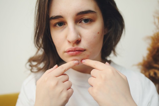 Kesalahan pakai pimple patch pada jenis jerawat yang salah/Foto: Pexels.com/Polina Tankilevitch Salah satu kesalahan pakai pimple patch adalah menggunakannya pada jenis jerawat yang kurang sesuai, seperti jerawat batu atau komedo. Kenali jenis jerawat sebelum memilih perawatan.