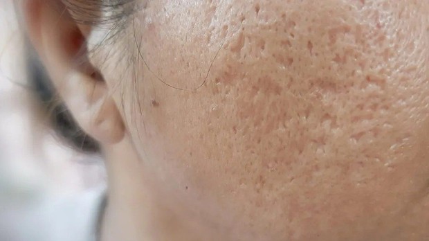 Boxcar scars adalah salah satu jenis acne scar