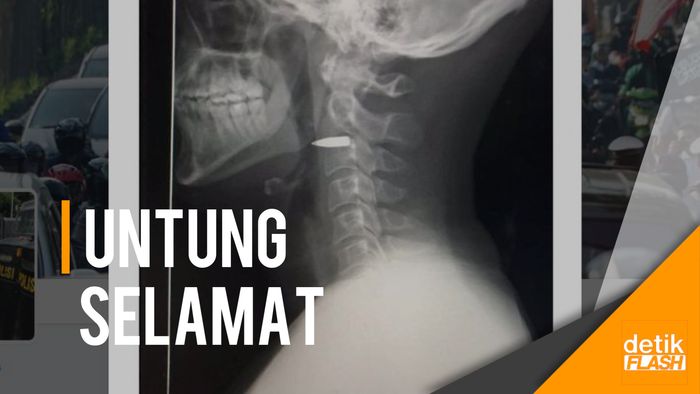 Timah Panas Bersarang di Leher Wartawan Asing