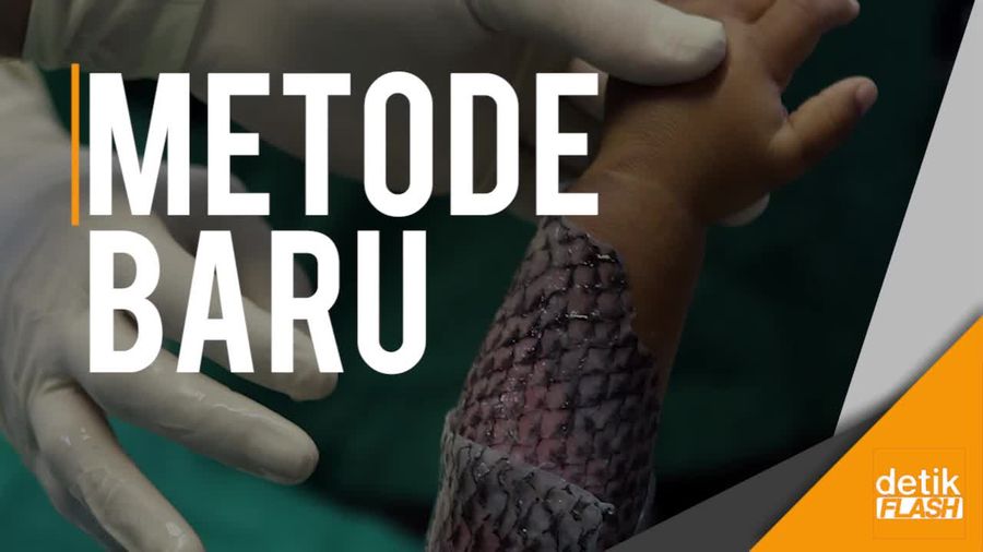  Efek Ampuh Kulit Ikan Obati Luka Bakar