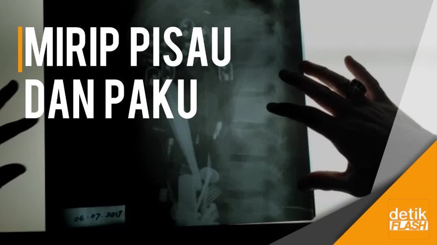Hii.. Ada Banyak Benda Tajam di Dalam Perut Pasien Ini