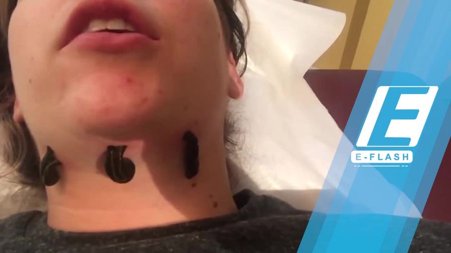 Rahasia Awet Muda Selebriti Dunia: Facial Lintah