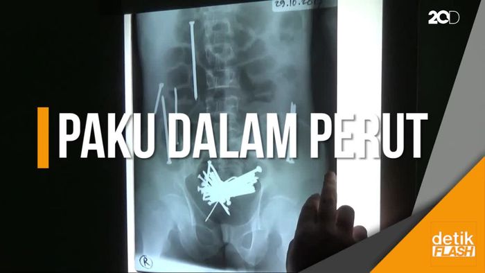 48 Paku Berkarat dan Gumpalan Rambut Dikeluarkan dari Perut Wawan 