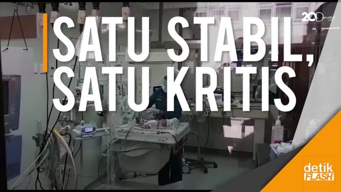 Hiks! Beginilah Kondisi Bayi Kembar Siam di RSHS Bandung