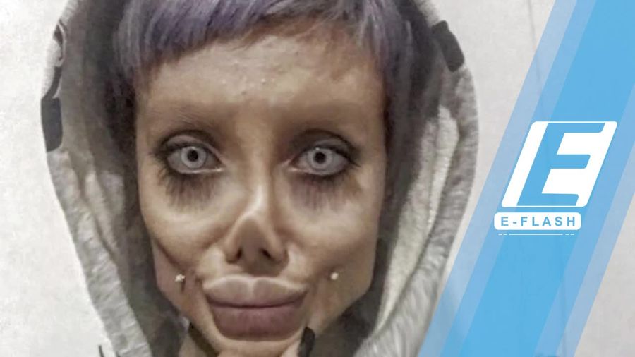 Terobsesi Angelina Jolie, Gadis Ini Nekat Oplas dan Diet Ketat