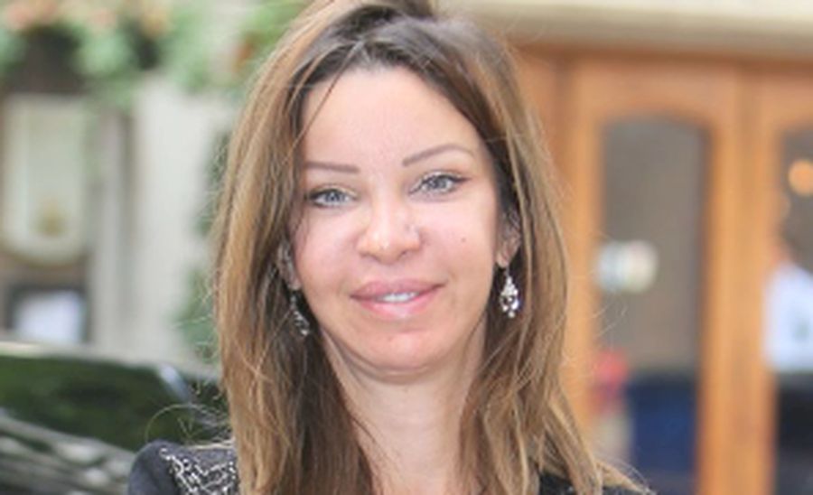 300 Kali Operasi Plastik, Wajah Perempuan Ini Berubah Seperti Alien