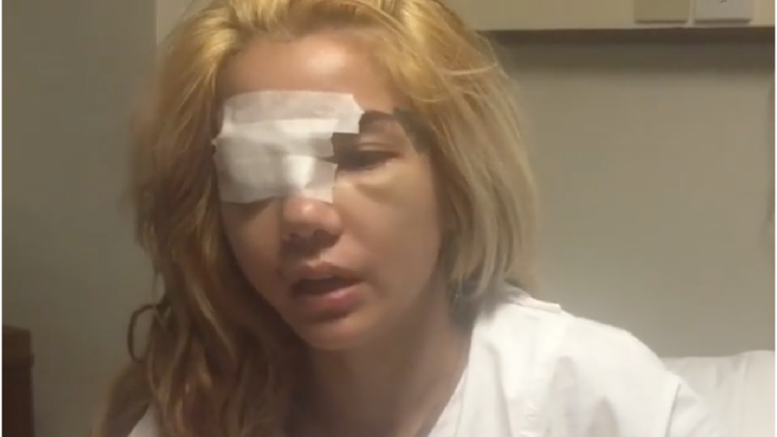 Dengan Mata Diperban, Sheila Marcia Jelaskan Kondisi Vanesha