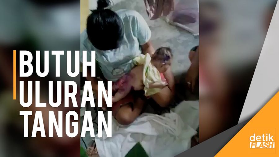 Hiks! Hati Siapa Tak Menangis Melihat Kondisi Bayi Friska