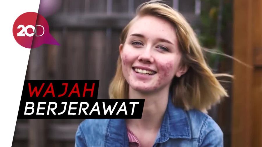Kisah Wanita yang Tampil Pede dengan Wajah Berjerawat