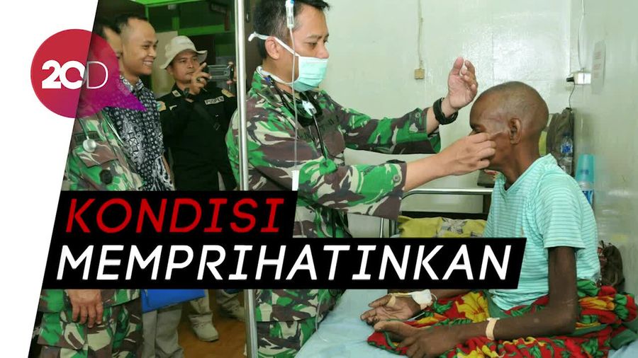Sedih! Begini Kondisi Warga Asmat yang Gizi Buruk