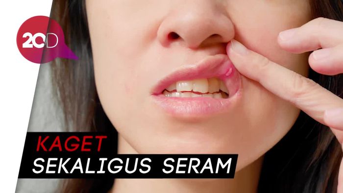 Netizen Ramai Soal BPOM Larang Albothyl untuk Sembuhkan Sariwan
