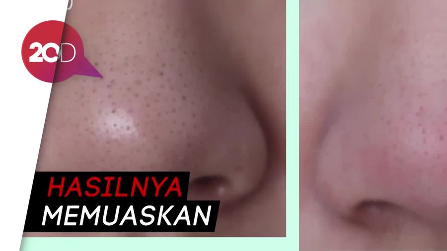 Beauty Vlogger Hilangkan Komedo Pakai Vaseline, Hasilnya?