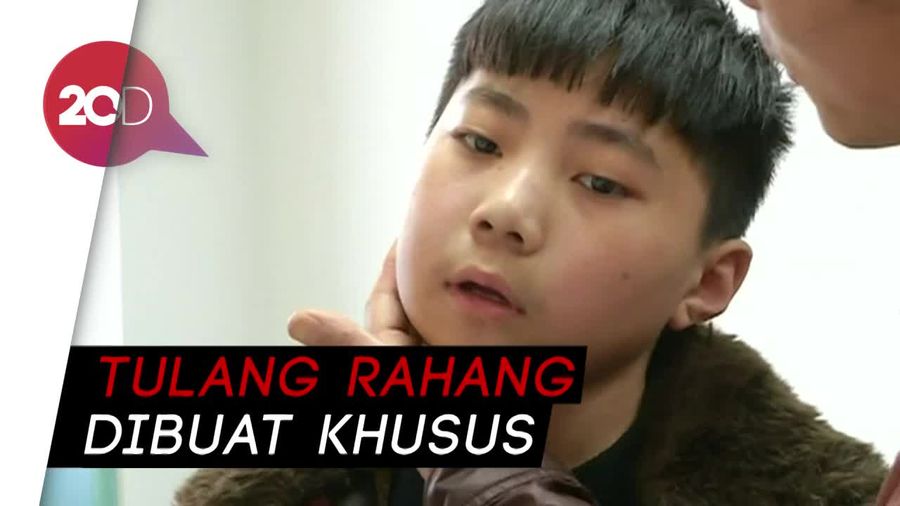 Wow! Bocah ini Dioperasi Tulang Rahang Pakai 3D Printer