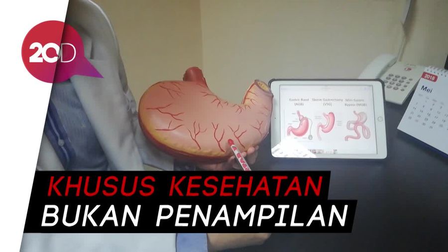 Bariatric Surgery, Metode Penurunan Berat Badan Aria Permana