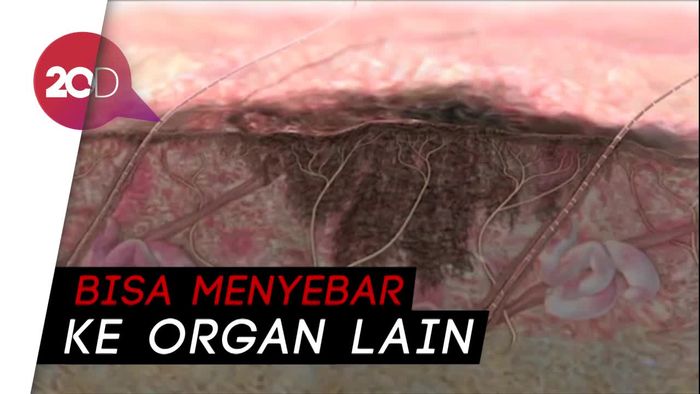Kenali Kanker Kulit Melanoma, Penyebab Kematian Istri Rasyid Rajasa