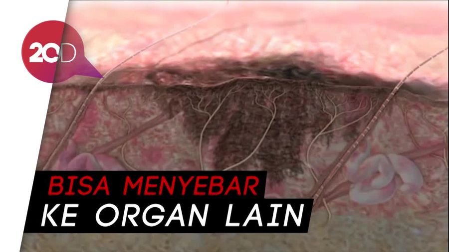 Kenali Kanker Kulit Melanoma, Penyebab Kematian Istri Rasyid Rajasa