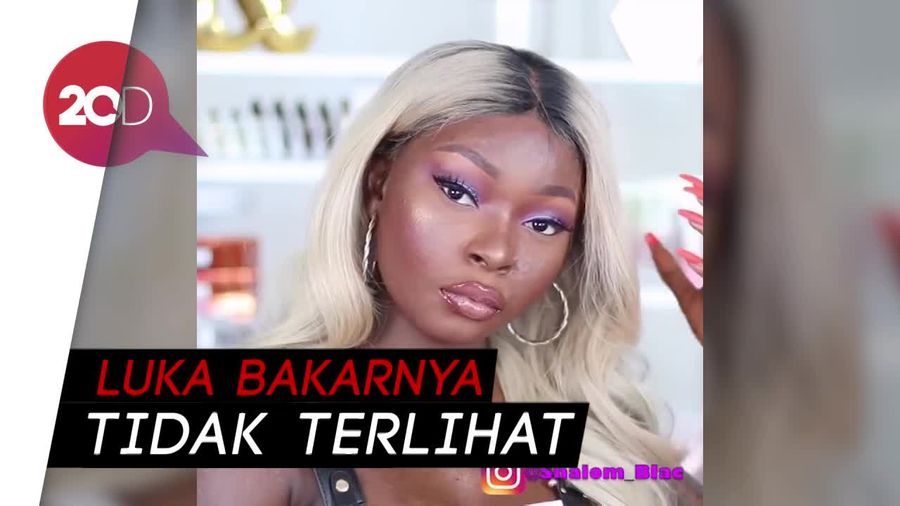Viral! Miliki Luka Bakar, Gadis Ini Bangkit dengan Pelajari Makeup